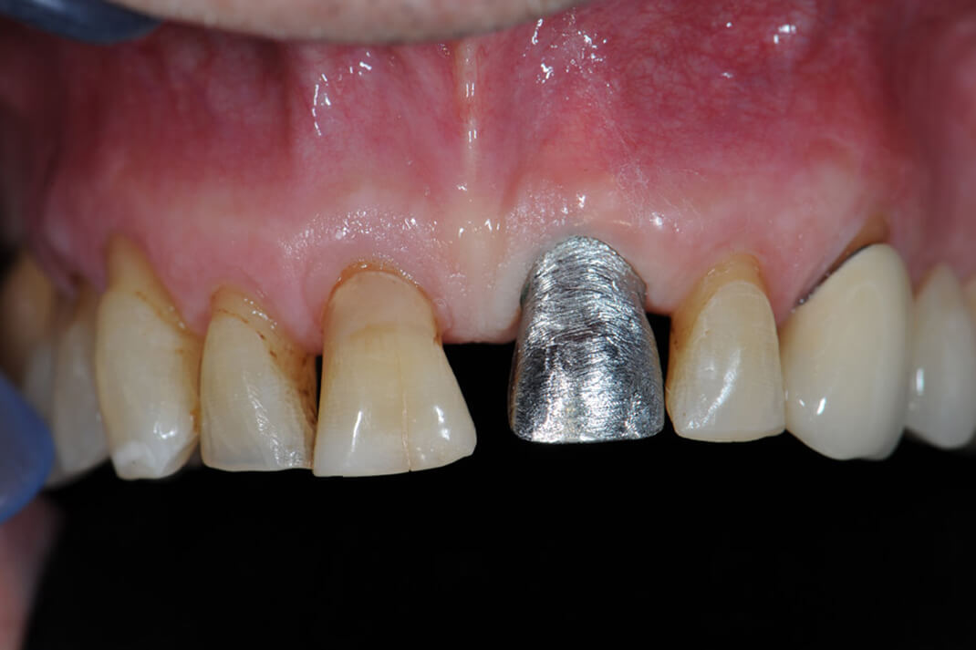Lavorazione odontotecnica corone in metallo-ceramica - Dettaglio lavorazione