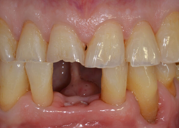 Maryland bridge con denti in composito stratificato