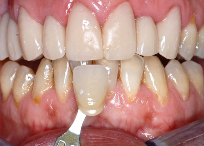 Riabilitazione estetica in zirconia