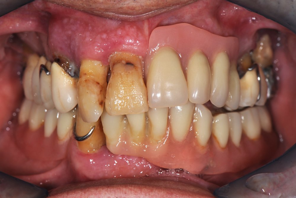 Riabilitazione totale inferiore e superiore su impianti in Metallo - Composito