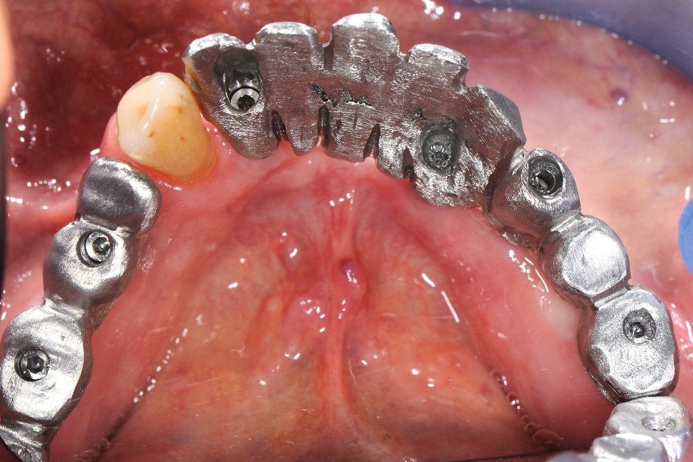 Riabilitazione totale inferiore e superiore su impianti in Metallo - Composito