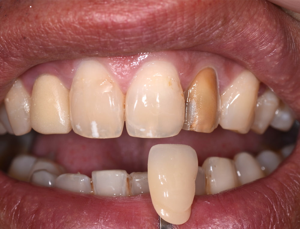 Dettaglio lavorazione odontotecnica faccete dentali