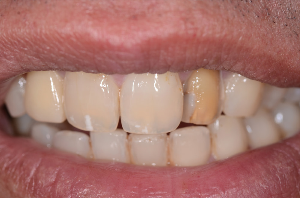 Quadrio clinico iniziale lavorazione odontotecnica faccette dentali