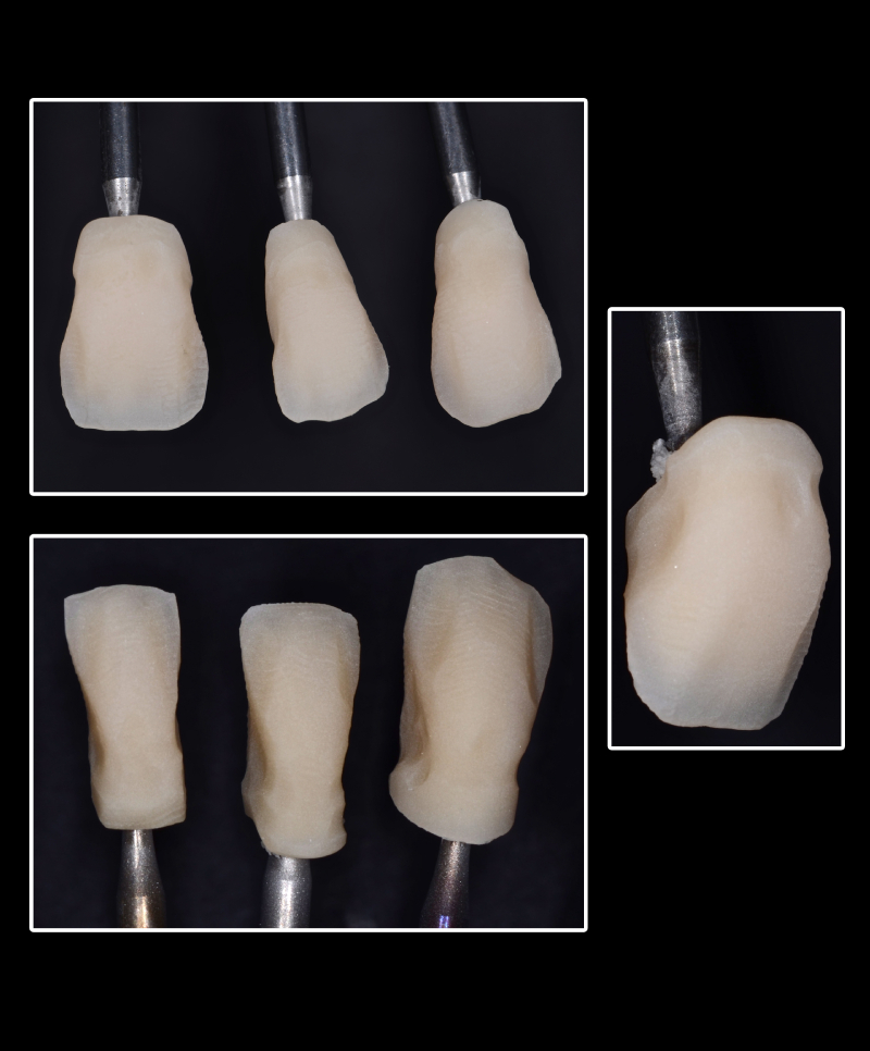 stratificazione riduzione denti