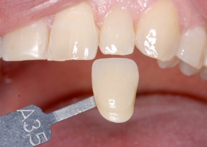 Faccetta dentale prepless senza preparazione