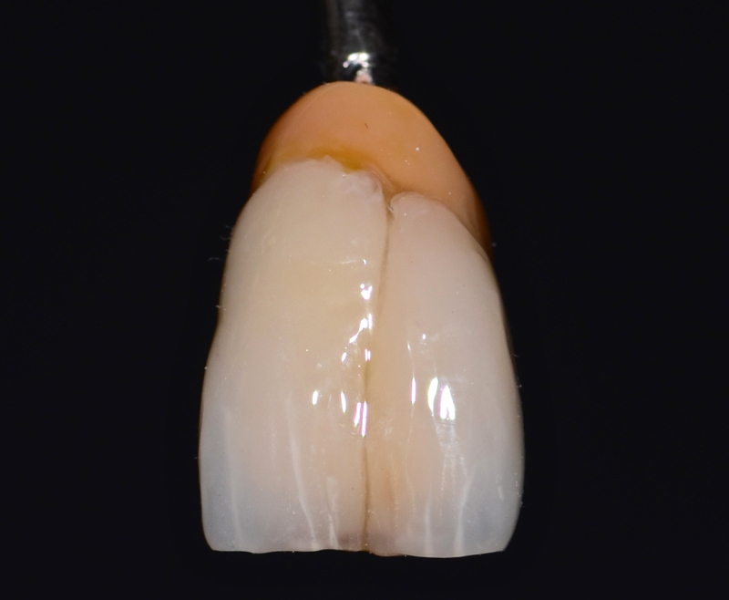 Stratifcazione composito / protesi dentali